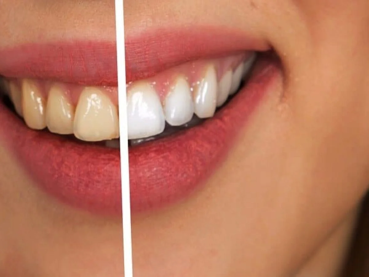 Dental Fluorosis