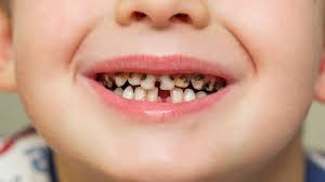 Early Childhood Caries