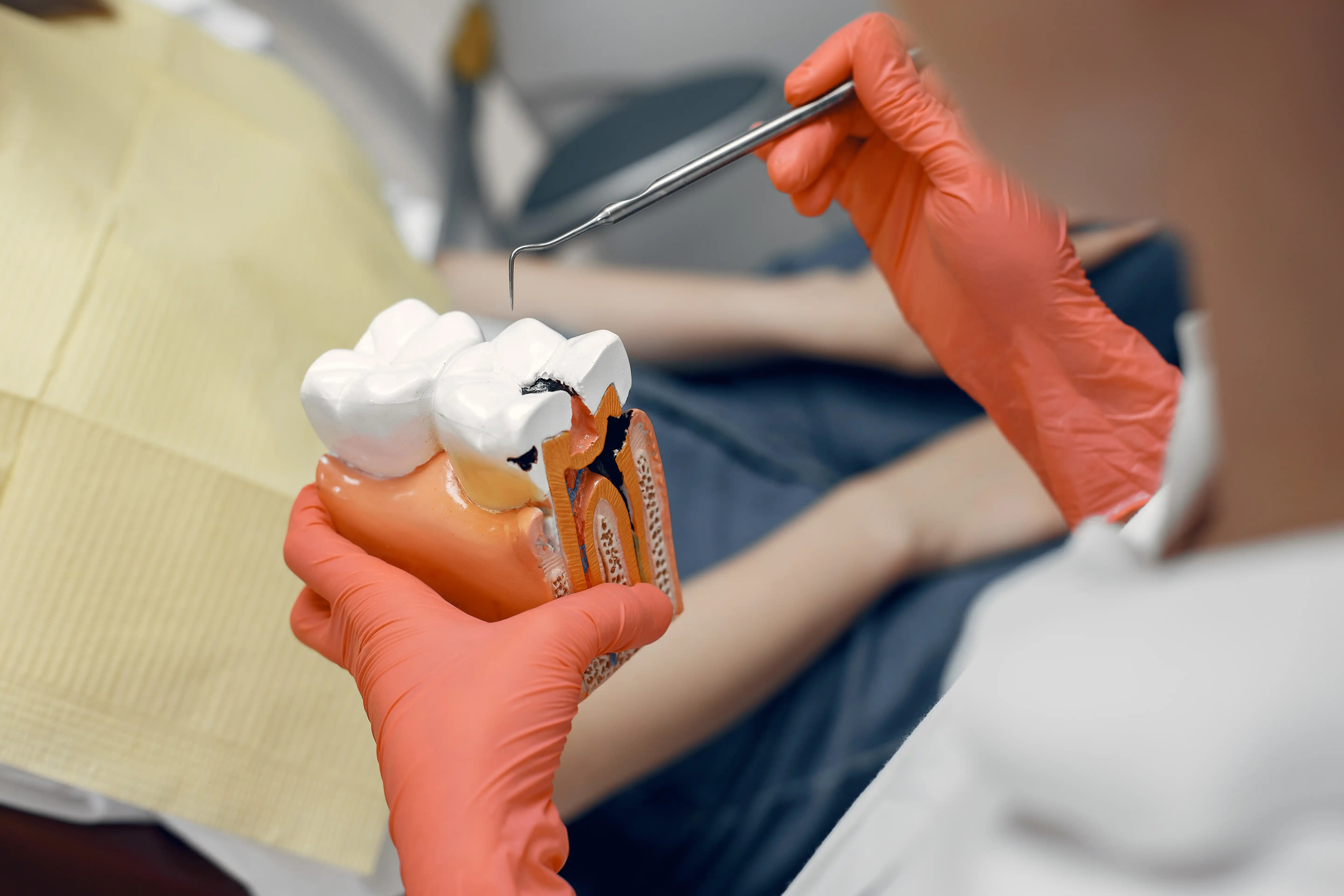 Dental Fillings